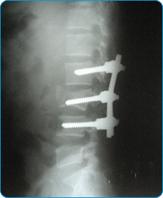 Post-operative x-ray of Donald Manurong Post-operative x-ray of Donald Manurong